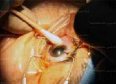 جراحی های متداول چشم