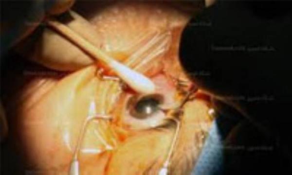 جراحی های متداول چشم