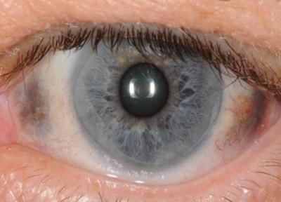 آشنایی با آلکاپتونوریا؛ بیماری عجیبی که رنگ ادرار و چشم را سیاه می نماید